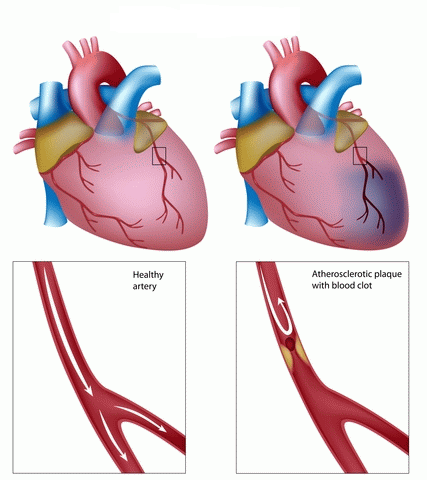 Coronary-Artery2